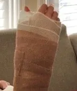 Torn Ligament